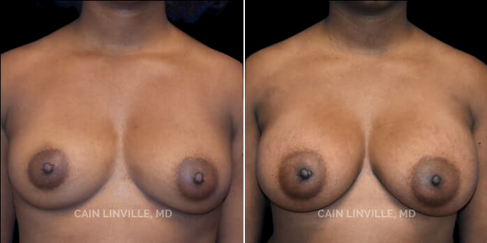 This is a 45 year-old mother of two, who desired a breast augmentation and a full look with upper pole fullness. She wanted to go from a small C cup to a large D cup. 420 cc gummy bear implants, dual plane I pocket. She has a great post-op outcome without capsular contracture, and good symmetry. She has excellent upper pole fullness without significantly widening the chest. She is also now extremely confident with her new look and loves the shape and size.