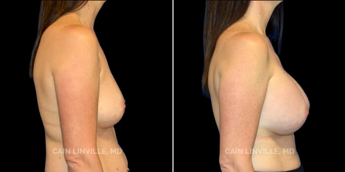 Patient 12 Right Side View Breast Augmentation Linville Plastic Surgery