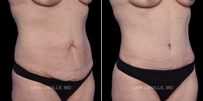 This patient is a 46 year old female who received a tummy tuck in combination with lipo 360 and bodytite 360. These photos are 3 months post op.