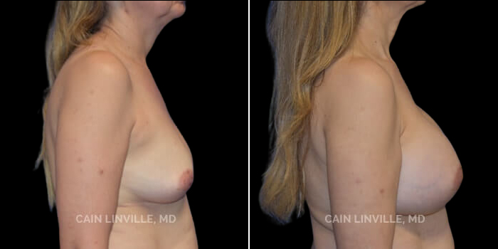 Patient 13 Right Side View Breast Augmentation Linville Plastic Surgery