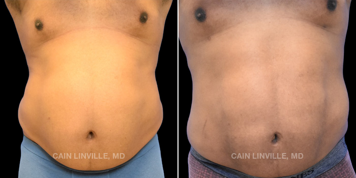 47 y/o male 6 months post op liposuction to abdomen, flanks, and back with abdominal etching