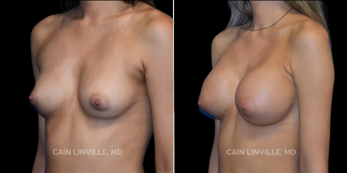 Patient 14 3/4th Left Side View Breast Augmentation Linville Plastic Surgery