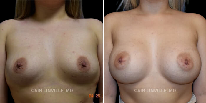 Patient 15 Front View Breast Augmentation Linville Plastic Surgery