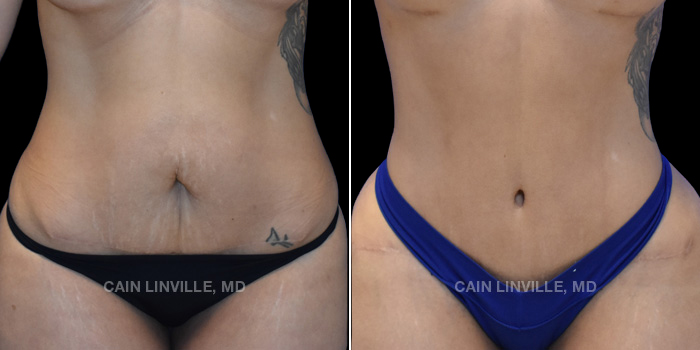 37 y/o female received a tummy tuck with liposuction 360. Photos are 1 year post op.