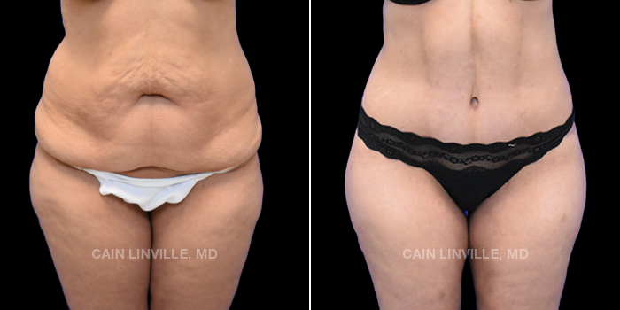 37 y/o female 4 months post-op: Tummy tuck Lipo to abdomen, flanks, bra line, and back Bodytite to back of thighs Fat grafting to buttocks
