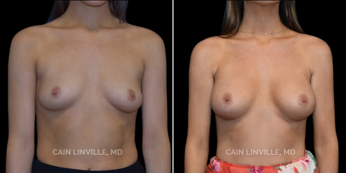 Patient 16 Front View Breast Augmentation Linville Plastic Surgery