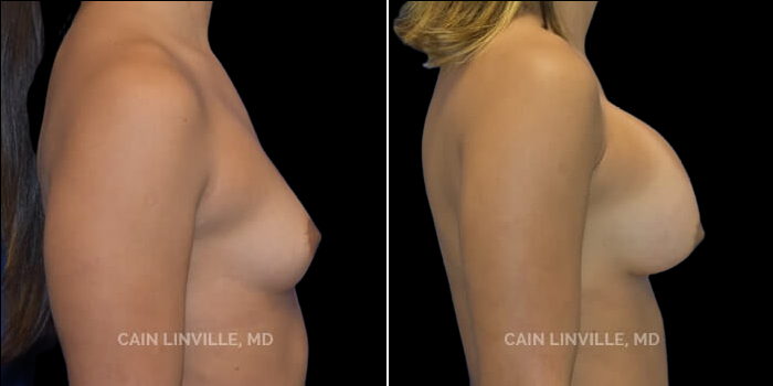 Patient 17 Left Side View Breast Augmentation Linville Plastic Surgery