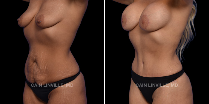 This patient is a 34 year old female who received a tummy tuck in combination with Lipo360, a mini BBL, and a breast augmentation. These photos are 3 months post op.