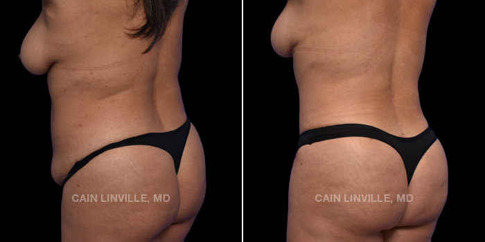 This patient is a 46 year old female who received a tummy tuck in combination with liposuction 360, a breast lift, and bodytite. These photos are 3 months post op.