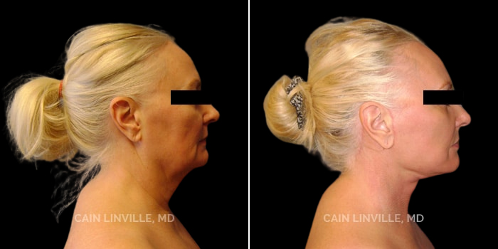 Patient 01 Right View Face and Neck Lift Linville Plastic Surgery