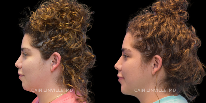 This patient is a 29-year-old female who wanted to achieve a natural-looking jawline using facetite and submental liposuction. These photos are 8 months post-op.