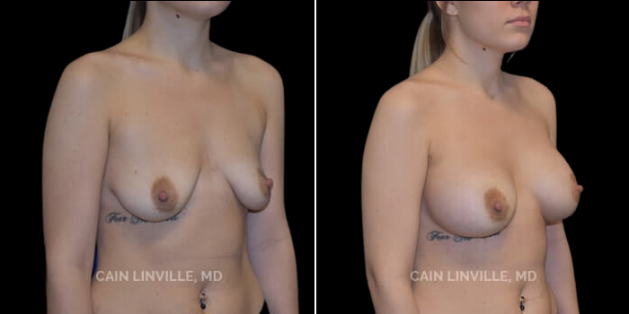 Patient 18 3/4th Right Side View Breast Augmentation Linville Plastic Surgery