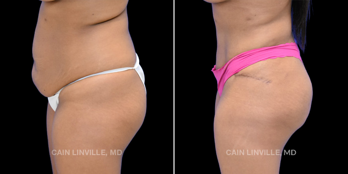 This patient is a 27 year old female who underwent a tummy tuck, 360 lipo with bodytite, and fat grafting to buttocks (BBL). These photos are 6 months post op.