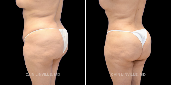 42 year old underwent tummy tuck revision, liposuction 360 with bodytite. Brazilian buttock lift with 800 cc injected on each side for shape and contour with bodytite to banana roll for improved buttock crease.