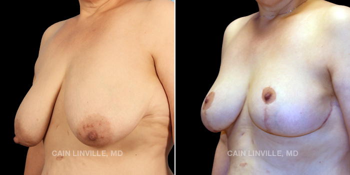 Patient #87 – 52 years old Procedures Depicted – Breast Reduction and Lift