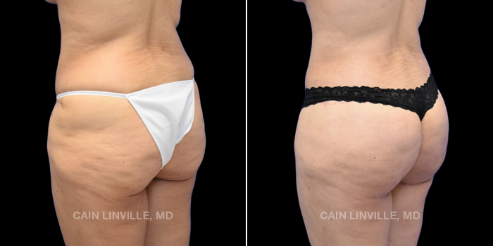 This patient is a 39 year old female who received a thigh lift, body lift, liposuction to abdomen, back, flanks, lateral thighs, medial thighs, submental area, and bra-line with bodytite to abdomen, flanks, bra-line, back, thighs, and arms. She also received facetite to the submental area with filler to her chin. The patient received fat grafting to her buttocks (BBL). These photos are 3 months post op.