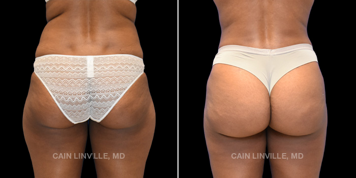 This patient is a 34 year old female who underwent a mini tummy tuck with lipo to abdomen and flanks and fat grafting to buttocks (BBL). These photos are 11 months post op.