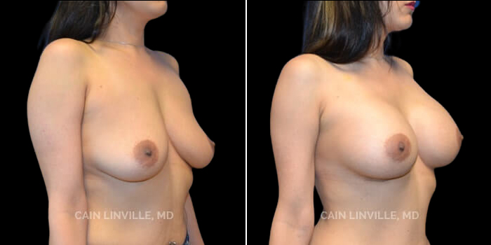 Patient 19 3/4th Right Side View Breast Augmentation Linville Plastic Surgery