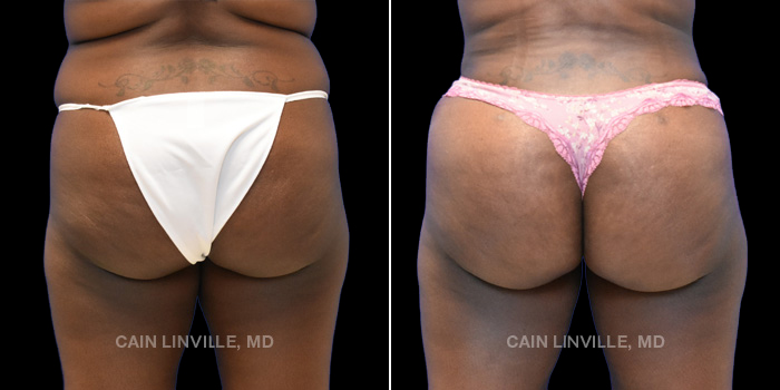 This patient is a 40 year old female who received a tummy tuck with liposuction to her abdomen and flanks with bodytite to her abdomen and flanks. She received fat grafting to her buttocks (BBL). These photos are 6 months post op.