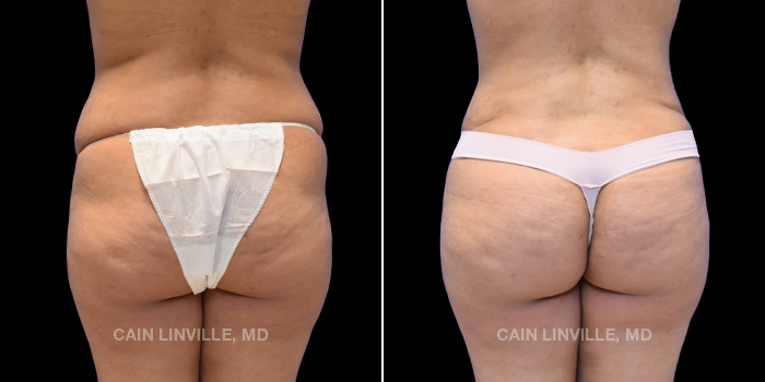 This patient is a 29 year old female who underwent an extended tummy tuck, lipo abdomen, flanks, inner thighs with bodytite, fat grafting to buttocks (BBL). These photos are 6 months post op.