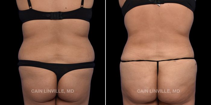 This patient is a 32 year old female who received a tummy tuck in combination with lipo360 and bodytite with fat grafting to the buttocks. These photos are 5 months post op.
