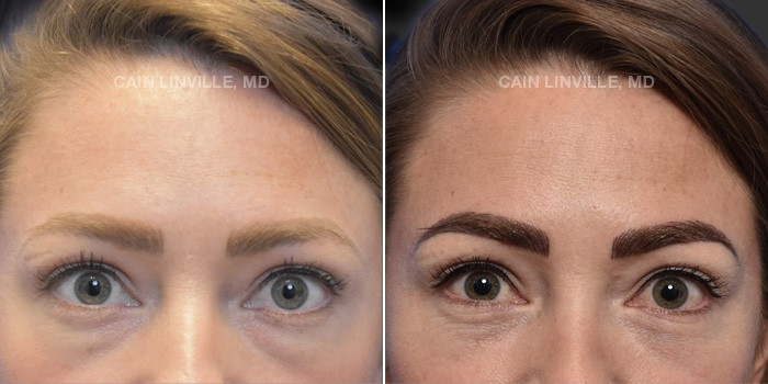 This patient is a 32 year old female who received a lower Blepharoplasty. These photos are 6 months post op.