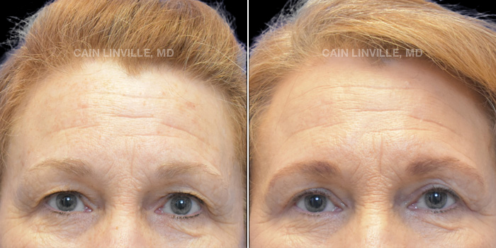 This patient is a 60 year old female who received an upper blepharoplasty. These photos are 1 month post op.