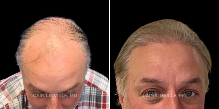 Patient 01 Front View Neograft Hair Restoration Linville Plastic Surgery