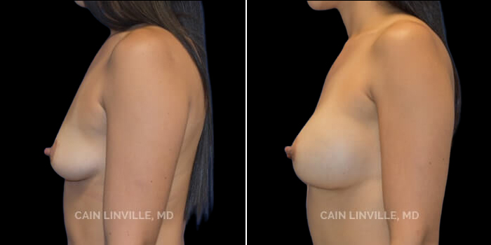 Patient 21 Left Side View Breast Augmentation Linville Plastic Surgery