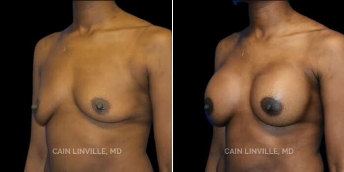 Patient 23 3/4th Right Side View Breast Augmentation Linville Plastic Surgery