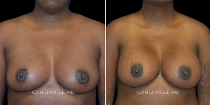 Patient 24 Front View Breast Augmentation Linville Plastic Surgery