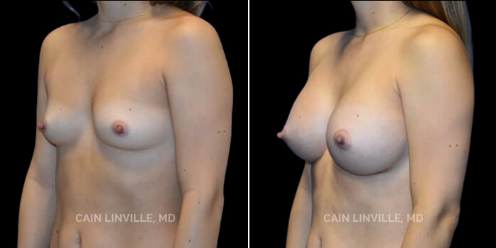 Patient 25 3/4th Left Side View Breast Augmentation Linville Plastic Surgery