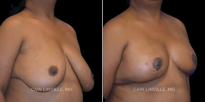 Patient 04 3/4th Right Side View Breast Reduction Linville Plastic Surgery