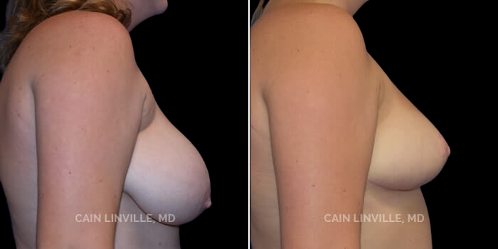 Patient 03 Right Side View Breast Reduction Linville Plastic Surgery