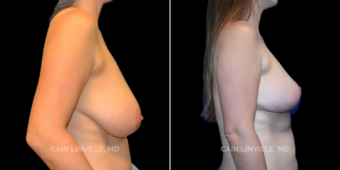 Patient 02 Right Side View Breast Reduction Linville Plastic Surgery