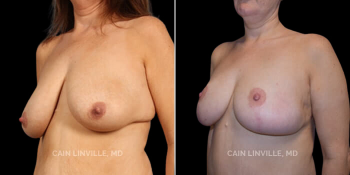 Patient 01 3/4th Left Side View Breast Reduction Linville Plastic Surgery
