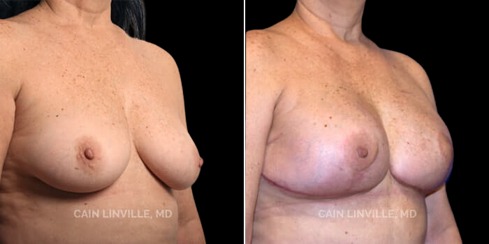 55 yo woman who underwent the new Three-Stage breast reconstruction, specifically used to reconstruct the ptotic breast. She initially had a lumpectomy with an oncoplastic breast reduction, which removes the tumor and lifts the breast and nipple-areola complex. Next, she had bilateral nipple-sparing mastectomies and simultaneous DIEP flap breast reconstruction. The third stage is simply a revision of her results (resection of skin paddle, fat grafting), and leaves her with a mommy-makeover look, where it appears as if she’s had a mastopexy and tummy tuck. She recently underwent another small revision to help with a couple of small issues and we will post her follow-up pics in a few months.