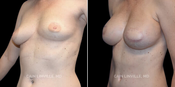This young 40 yo woman had previously had left breast cancer treated with a lumpectomy and radiation several years ago. She then recurred, and opted for bilateral mastectomies. Due to the radiation, she underwent immediate DIEP flap reconstruction, and followed this up with implant placement and fat grafting. She was too thin to be able to achieve her size goal with fat grafting alone, hence the implant. She has opted not to do nipple reconstruction, and instead is going to get a floral tattoo, which we are anxious to see and show. I do like that her result is a good demonstration of how the DIEP flap can reconstruct the breast tissue so to speak, and if followed up with an implant, it can give a slightly enhanced look, almost like an augmentation.