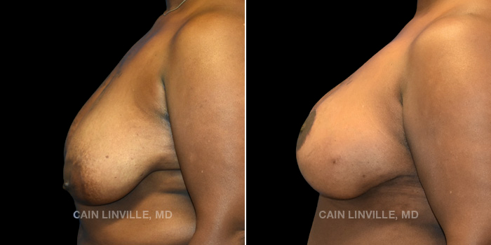 48 year old female underwent three stage reconstructive surgery. First consisted of a bilateral breast lift, followed with a bilateral DIEP flap. Ending with bilateral fat grafting