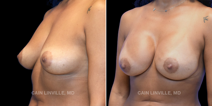 44-year-old female underwent reconstructive surgery. Bilateral tissue expanders replaced with silicone anatomically shaped breast implants and fat grafting.