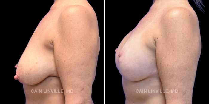 This patient desired a lift with a slight increase in size while still achieving a natural look. She is 51 years old and received a breast lift with implants of size 360cc. These photos are 4 months post op.