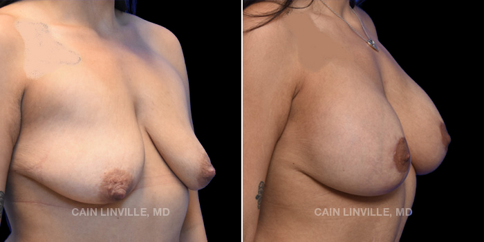 Patient 12 3/4th Right Side View Breast Lift Linville Plastic Surgery