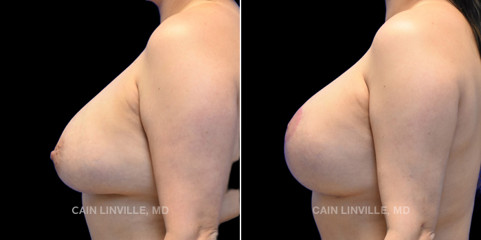 Patient 11 Left Side View Breast Lift Linville Plastic Surgery
