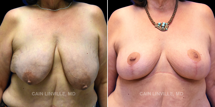 This patient is a 66 year old female who received a breast lift as well as fat grafting to her breasts. These photos are 4 months post op.