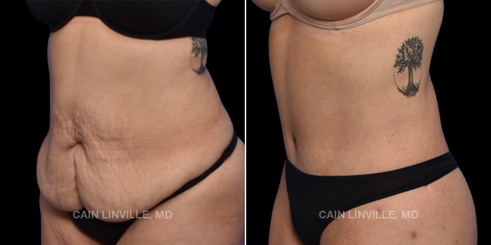 This patient is a 50 year old female who received a tummy tuck in combination with liposuction 360, bodytite 360, and a Brazilian buttock lift. These photos are 3 months post op.