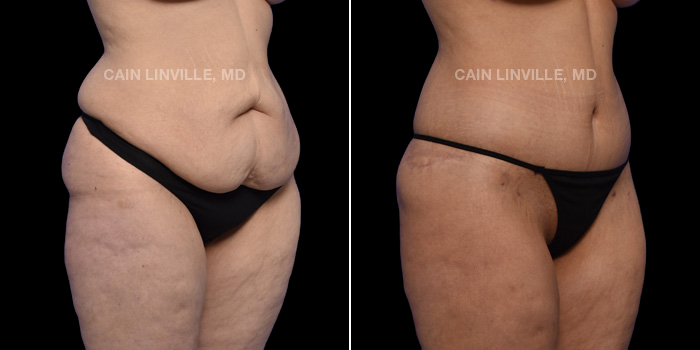This patient is a 35 year old female who received a tummy tuck in combination with lipo to her entire abdomen, back, flanks, bra-line, inner and outer thighs. She also received a buttock lift. These photos are 6 months post op.