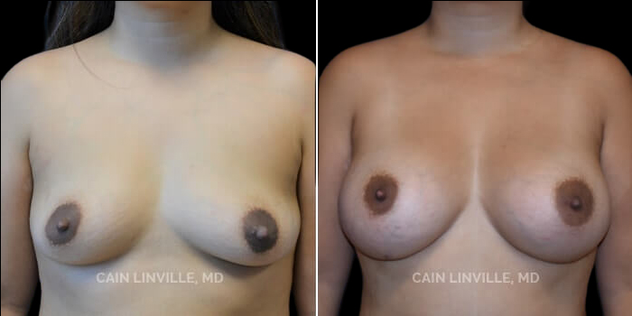 This young mother had breast asymmetry and sought out augmentation to give her an increase in size and correction of her asymmetry. She wanted to maintain a natural look while enhancing size and symmetry. 340 cc responsive gel round implant, dual plane 0.5 pocket, inframammary incision. 200 cc of fat second stage back grafting. Utilizing both responsive gel and fat from back grafting, she was able to achieve a more natural appearance. Her result gave her a natural slope, increase in volume, and symmetry that she wanted.