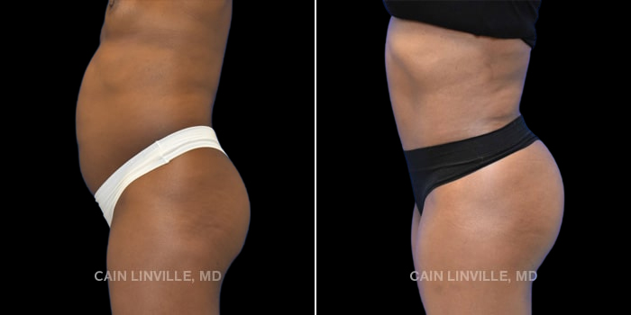55-year-old underwent tummy tuck with liposuction to abdomen, waist, back and hernia repair.Along with Brazilian buttock lift.