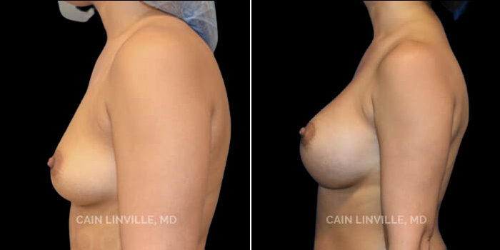 Patient 09 Front View Breast Augmentation Linville Plastic Surgery