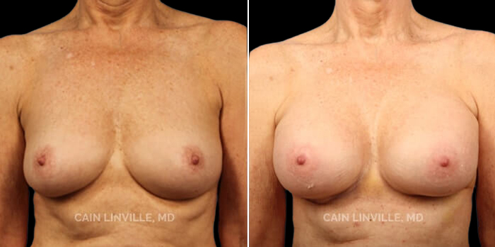Patient 10 Front View Breast Augmentation Linville Plastic Surgery
